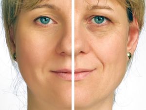 rejuvenescimento do rosto antes e depois cirurgia pálpebras rejuvenescimento-do-rosto-antes-e-depois-cirurgia-pálpebras
